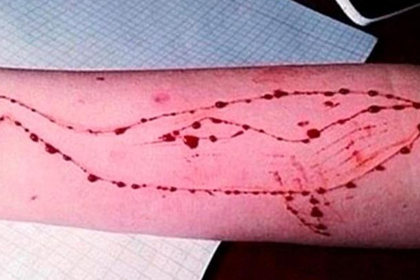 Bengal teen hospitalised after playing suicidal Blue Whale Challenge - Kolkata News in Hindi