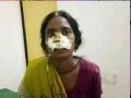 Dowry greedy husband absconded with wife nose